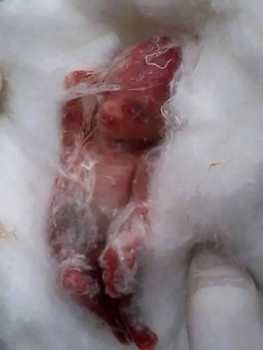 إحالة سيدة “جنين القمامة” للطب الشرعي بالبحيرة