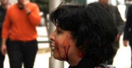 بالفيديو| الطب الشرعي: إصابة شيماء من خرطوش يوجد مع الشرطة