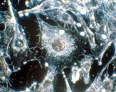 فريق أميريكى يستخدم تقنية جديدة لتدمير الخلايا السرطانية