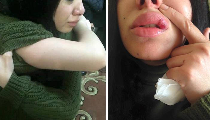 شقيقة ميرهان حسين تنشر صورًا تظهر الاعتداء عليها