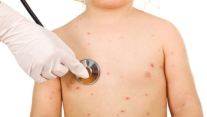 إصابة 21 طالب بالغدة النكافية والجديري المائي في أسيوط