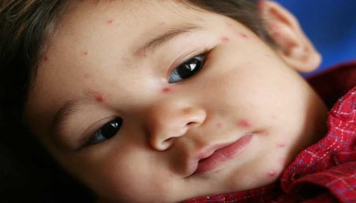 إصابة 13 تلميذًا بالجدري في أسوان