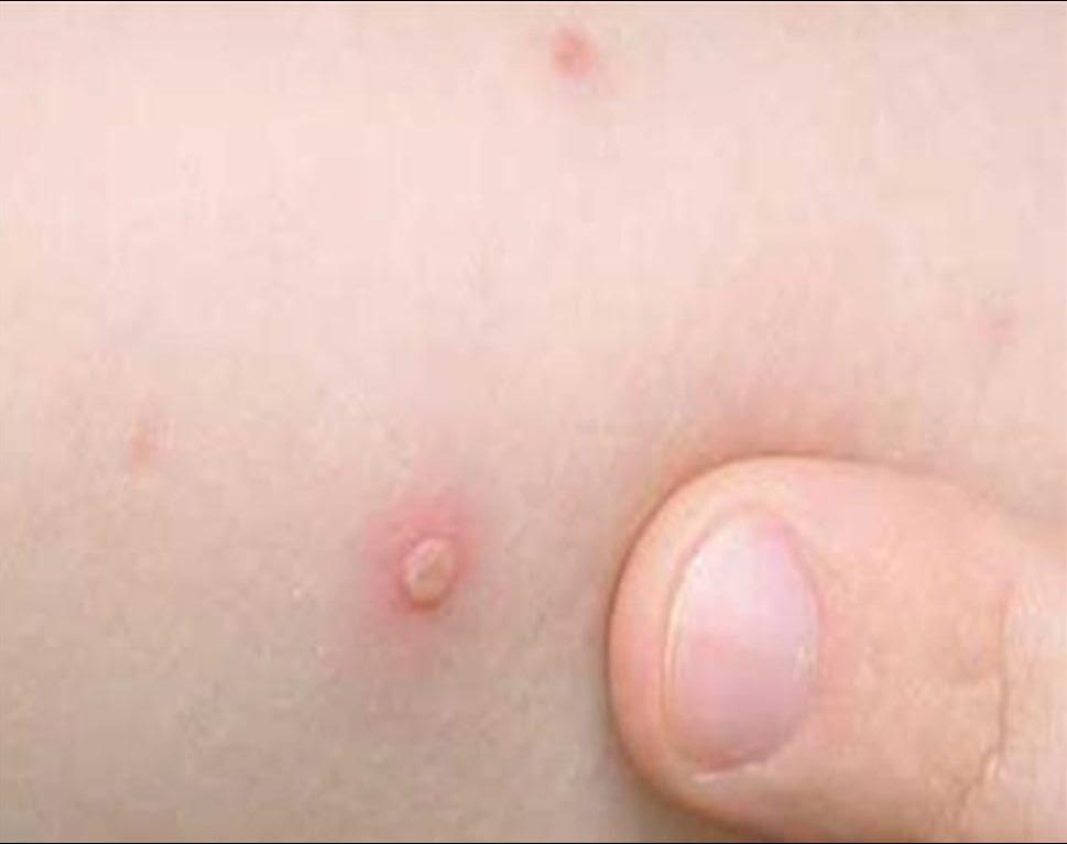 إصابة 108 تلميذا بالجدري الكاذب بسوهاج