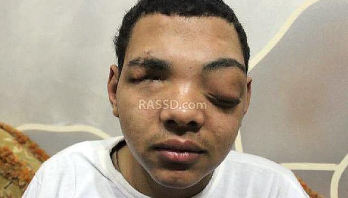 بالصور.. رصد تنفرد بحكاية “طفل” فقد عينيه في مذبحة رابعة