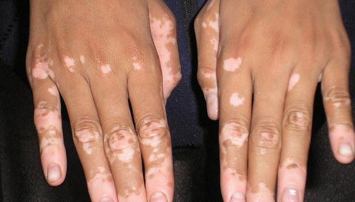 تصاعد العنف ضد مصابي البرص في تنزانيا مع اقتراب موعد الانتخابات