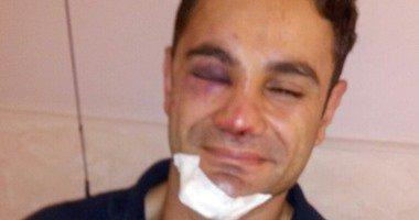 حراسة المطرب “حماقي” تعتدي بالضرب على رائد شرطة وتصيبه بارتجاج في المخ