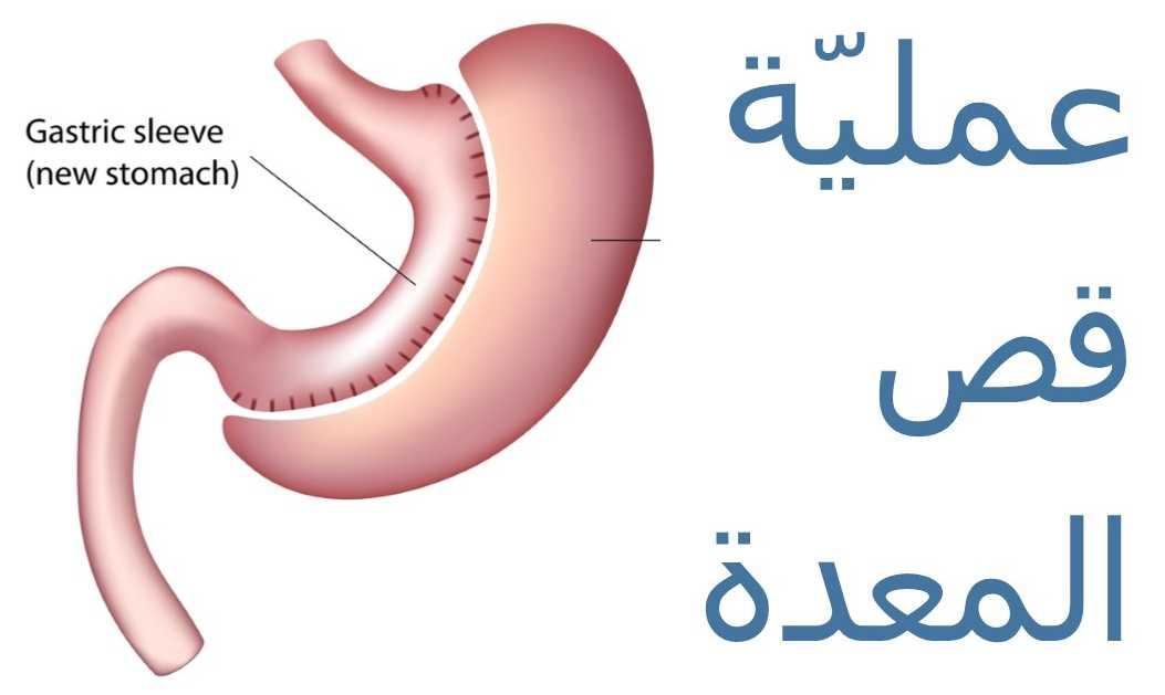 عملية قص المعدة وتصغيرها إلى حجم موزة تتصدر عمليات إنقاص الوزن
