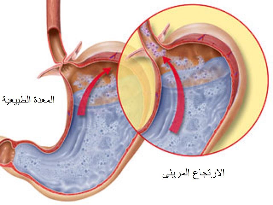 تعرف علي أسباب ارتجاع المريء وكيفية علاجه