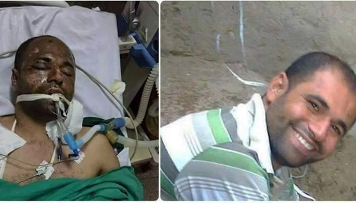 بعد بتر قدمه.. معتقل بالبحيرة يتعرض للموت البطيء بعد رفض علاجه