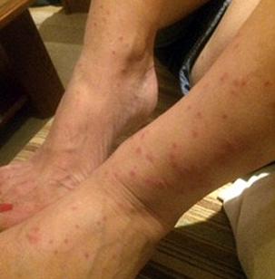 أسرة بريطانية تحصل على 11 ألف إسترليني من فندق مصري بسبب حشرة “البق”