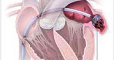 استشارى قلب: اضطراب نبضات القلب مؤشر للإصابة بأمراض خطيرة