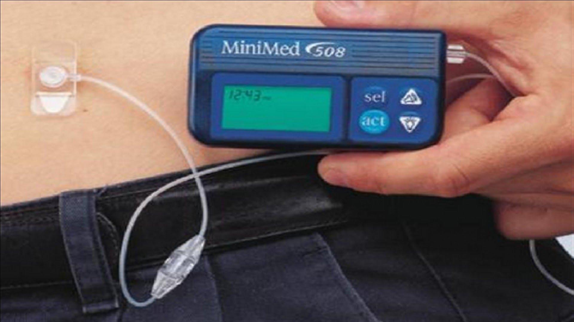 ابتكار بنكرياس صناعي لمرضى السكر يعمل عن طريق الهاتف