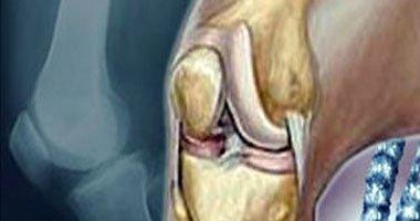 باحثون يتوصلون لطريقة جديدة فى علاج التهاب المفاصل