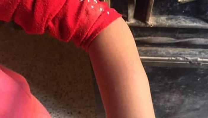 إحالة مدرسة للتحقيق بسبب تورم يد طالبة بأسيوط