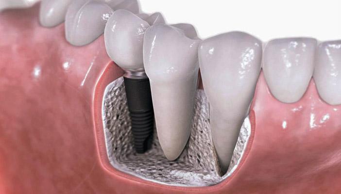 بالفيديو.. تقنية جديدة لزراعة الأسنان في نصف ساعة