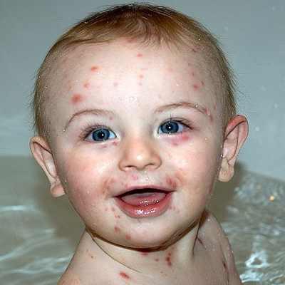 ارتفاع إصابات الجديرى المائى بمدارس دمياط لـ 21 حالة