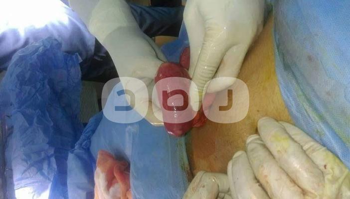 بالصور.. أطباء يعثرون على “ألف جنيه” داخل أمعاء أحد المرضى