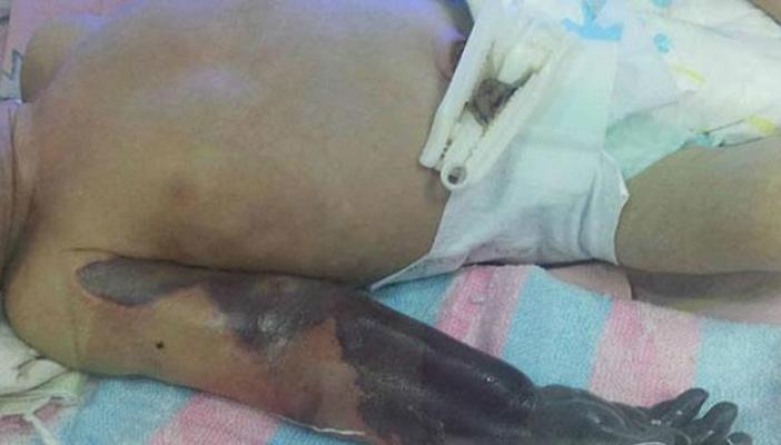 وفاة الرضيع الذي أجريت له عملية بتر ذراع  بسبب الإهمال الطبي