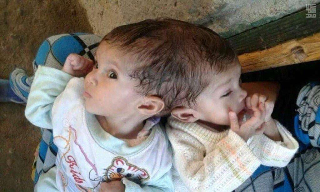 العاهل السعودي يوجه بعلاج توأم مصري ملتصق