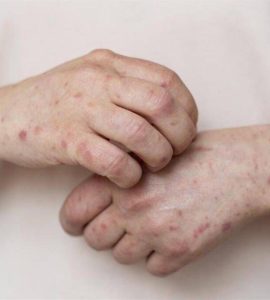 جدري القردة